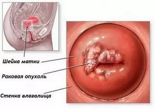 Вірус папіломи людини на шийці матки: як лікувати?
