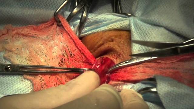Операція Мармара при варикоцеле: техніка проведення та післяопераційний період