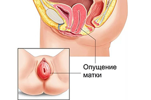 Операція при опущенні матки: коли застосовують і відновлення після операції