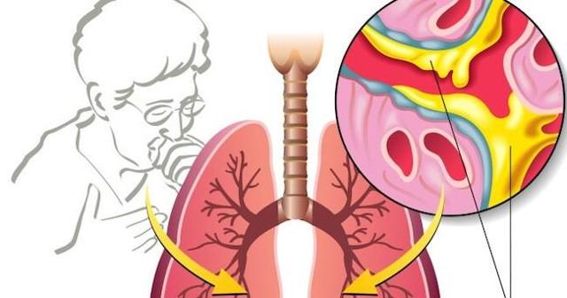 Змішана бронхіальна астма - причини, симптоми і лікування