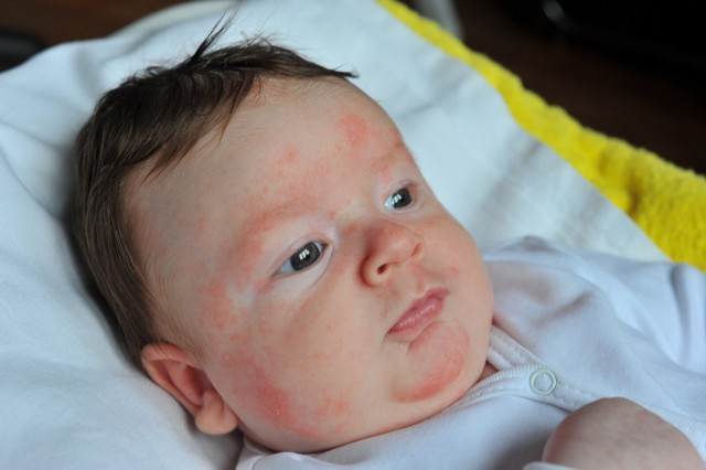 Алергія на солодке у дітей: симптоми і лікування