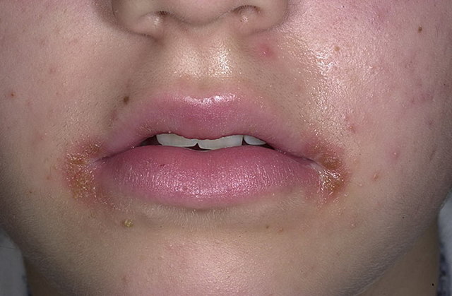 Періоральний дерматит: фото на обличчі, підборідді і у дітей