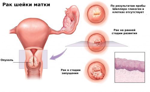 Передраковий стан шийки матки: що це значить, способи лікування і причина захворювання