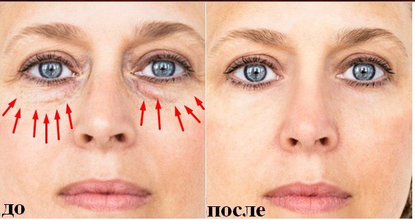 Набряки під очима набряки під очима: причини і лікування у жінок і чоловіків, як швидко позбутися