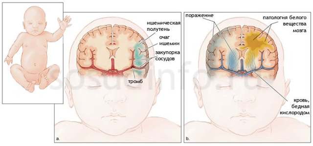 Ішемія головного мозку в літньому віці: симптоми і лікування, наслідки