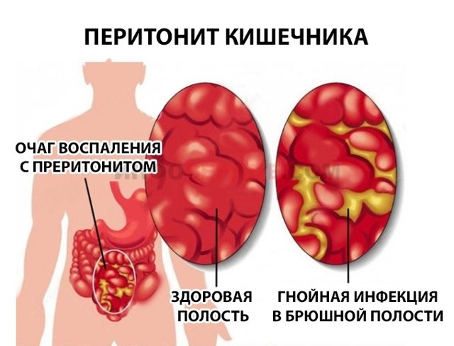 Тромбоз мезентеріальних судин кишечника: причини і методи лікування