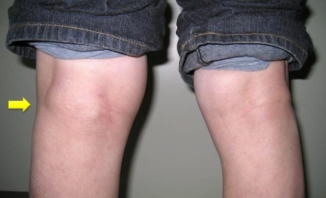 Розміри кісти Бейкера колінного суглоба для операції, її пункція