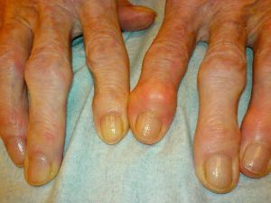 Хвороби суглобів пальців рук: види, причини, симптоми і лікування