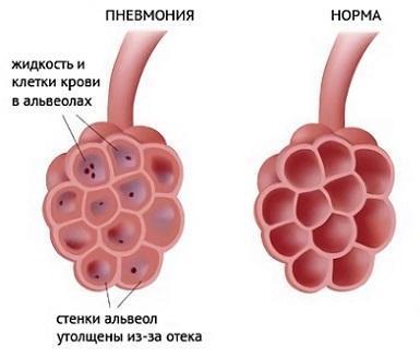 Класифікація хрипів при пневмонії