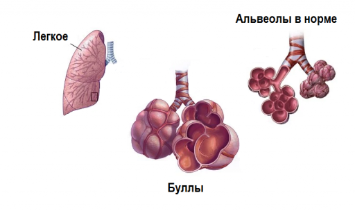 Бульозна хвороба легенів: симптоми, лікування і прогноз