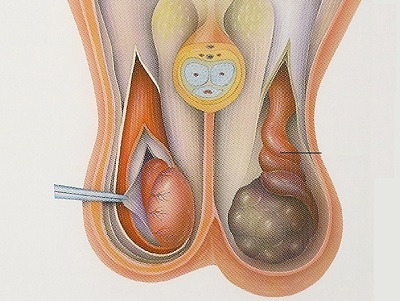 Видалення кісти придатка яєчка у чоловіків: операція, реабілітація та профілактика