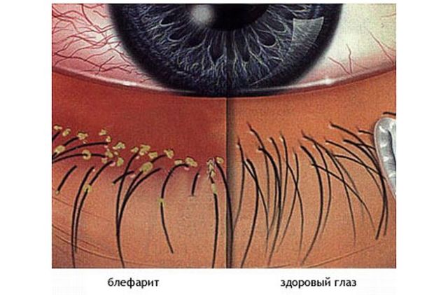 Блефарит очі: симптоми і лікування, фото, причини виникнення, як вилікувати у дорослих