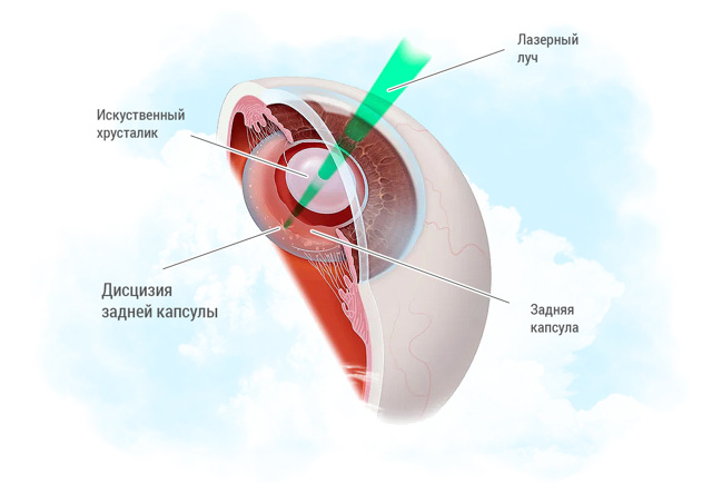 Вторинна катаракта після заміни кришталика: лікування, симптоми, протипоказання лазерної дісцізія