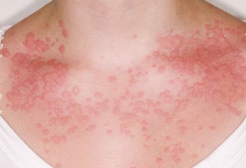 Алергія на продукти: чому виникає і на які продукти найчастіше?