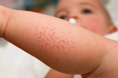 Алергія у дітей, фото різної висипу на тілі, обличчі і спині