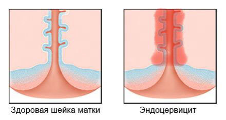 Цервіцит і ендоцервіцит шийки матки, що це таке