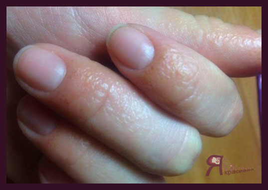 Алергія на гель-лак: чим лікувати пальці і руки?