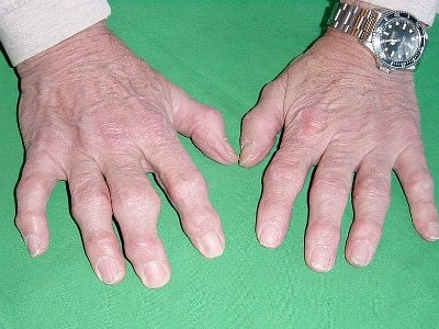 Артроз пальців рук: причини, симптоми і лікування, в домашніх умовах