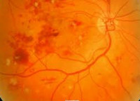 Діабетична ретинопатія очей: лікування, симптоми при цукровому діабеті