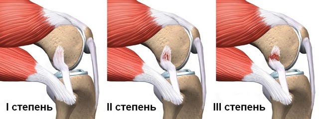 Лігаментоз колінного суглоба: що це таке, причини, симптоми і лікування
