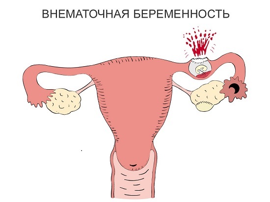 Біль внизу живота (ліворуч, праворуч, посередині) у жінок: причини і лікування