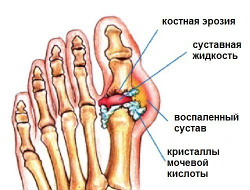Відкладення солей в суглобах (ніг і рук): симптоми, лікування, народні засоби