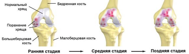 Вправи Бубновського для колінних суглобів: в домашніх умовах, на тренажерах