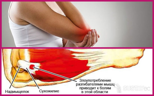 Пухлина на ліктьовому суглобі: причини, що робити, гарячий, червоний суглоб, біль