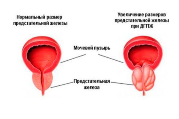 Простаторея: симптоми і лікування дефекаційний і мікціонних форми у чоловіків