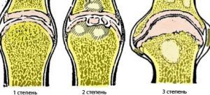 Гонартроз 3 ступеня колінного суглоба: що це таке, симптоми і лікування