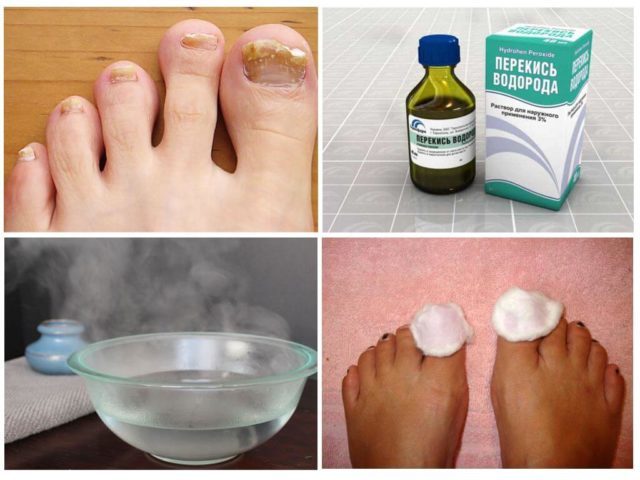 Доктор Неумивакин: лікування содою і перекисом водню, як вилікувати грибок нігтів