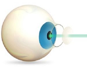 Пахіметрія рогівки ока: норма показників, різновиди, підготовка