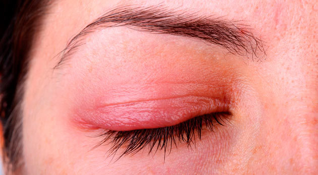 Блефарит очі: симптоми і лікування, фото, причини виникнення, як вилікувати у дорослих