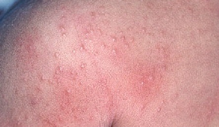 Алергія на сонце - типи, симптоми і профілактика