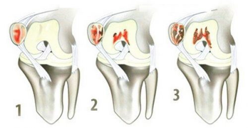 Пателлофеморальний артроз колінного суглоба: причини, ступеня, лікування