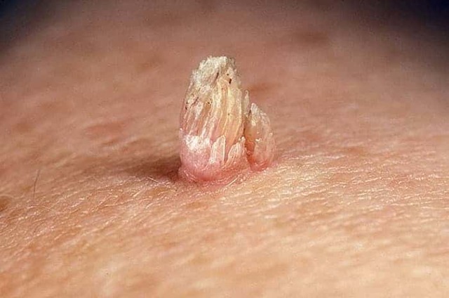 Кондиломи в піхву і на статевих губах: як виглядає і чим лікувати