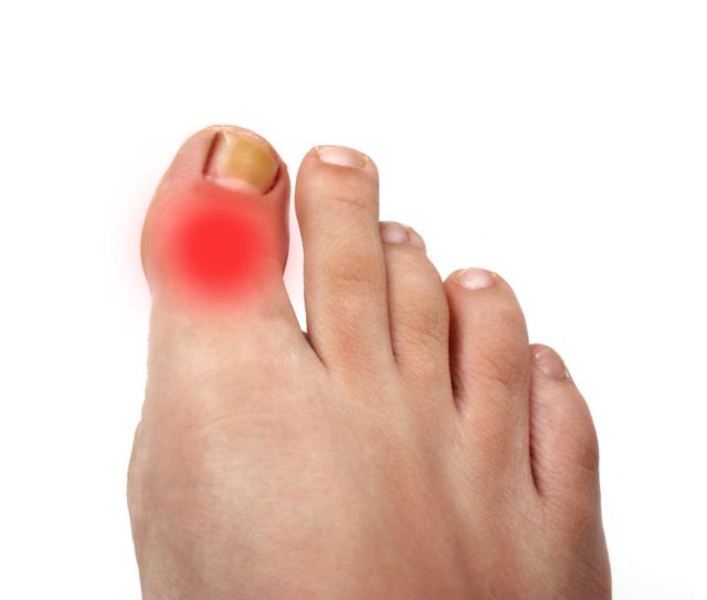 Артрит пальців ніг: симптоми і лікування, причини, ураження великого пальця
