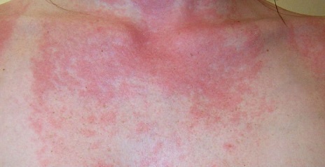 Алергія на сонце - типи, симптоми і профілактика