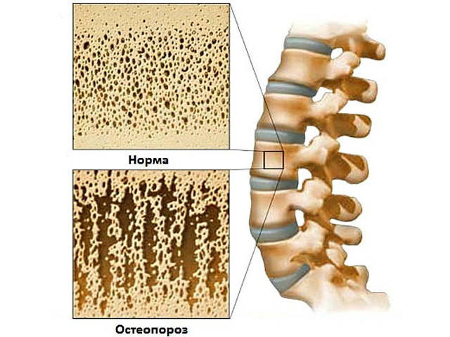 Профілактика остеопорозу у жінок і чоловіків: до 40, 50 років і після