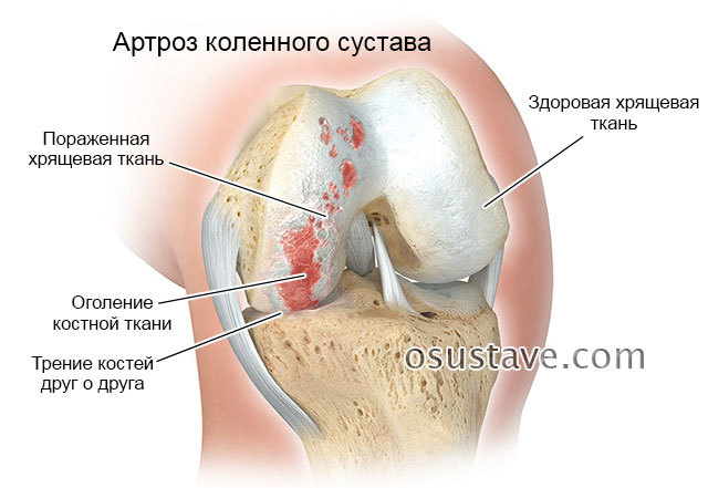 Наколінники при артрозі колінного суглоба: як вибрати, ефективність, показання