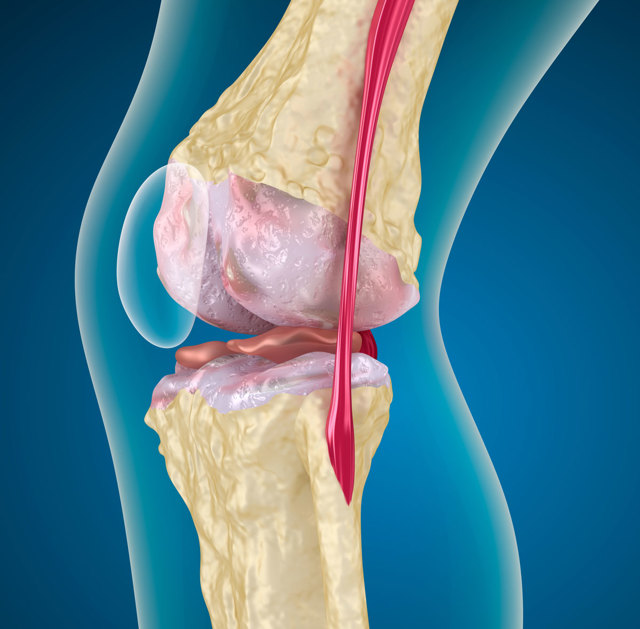 Пателлофеморальний артроз колінного суглоба: причини, ступеня, лікування