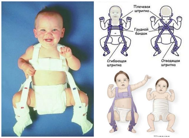 Дисплазія тазостегнових суглобів у новонароджених і немовлят: причини, лікування